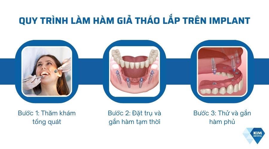 Quy trình làm hàm tháo lắp trên Implant