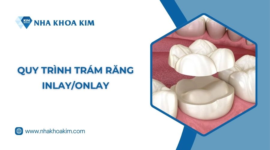 Quy trình thực hiện trám răng Inlay/Onlay
