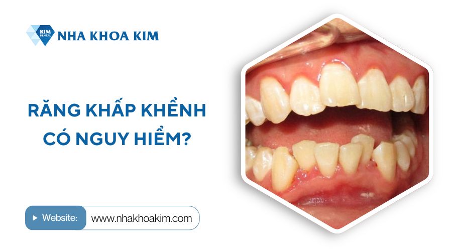 Răng khấp khểnh có nguy hiểm không?