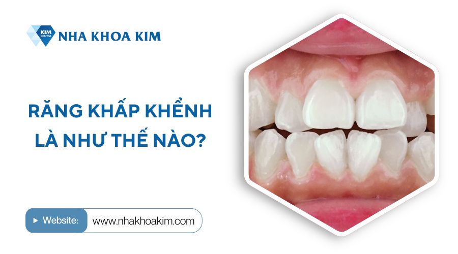 Răng khấp khểnh là như thế nào?