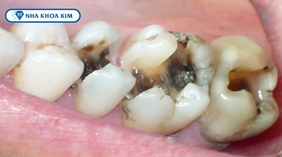 Hình ảnh sâu răng bán phần