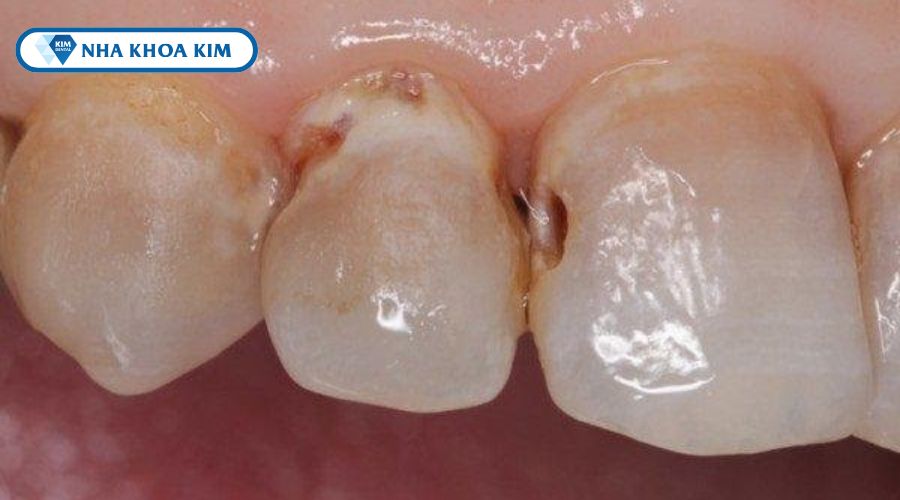 Hình ảnh sâu răng bề mặt