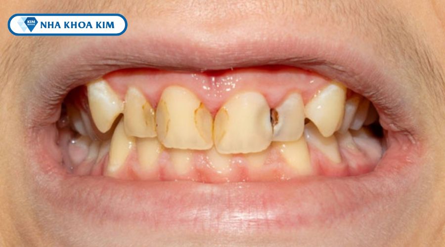 Hình ảnh sâu răng cửa