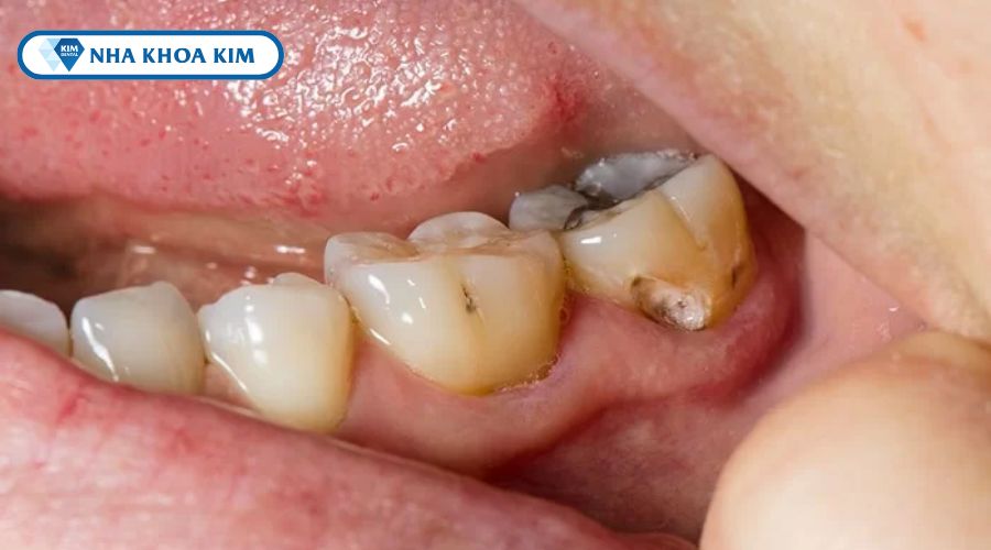 Hình ảnh sâu răng hàm lớn (răng khôn)