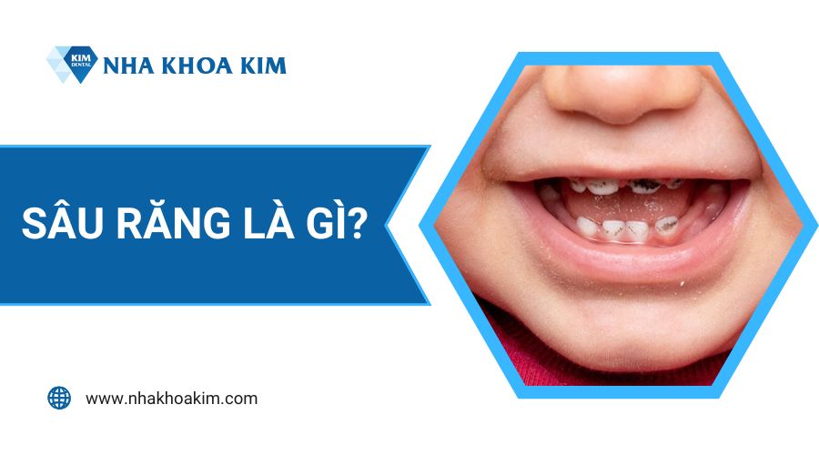Sâu răng là gì?