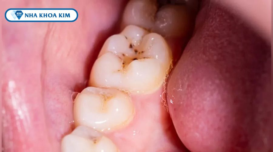 Hình ảnh sâu răng mức độ 1