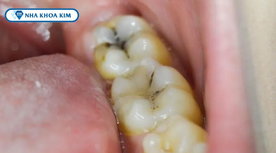 Hình ảnh sâu răng mức độ 2