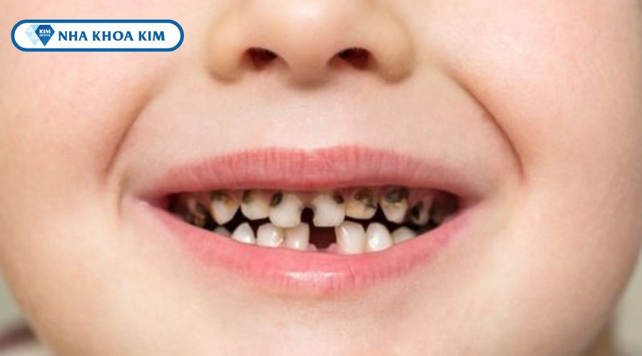Hình ảnh sâu răng trẻ em
