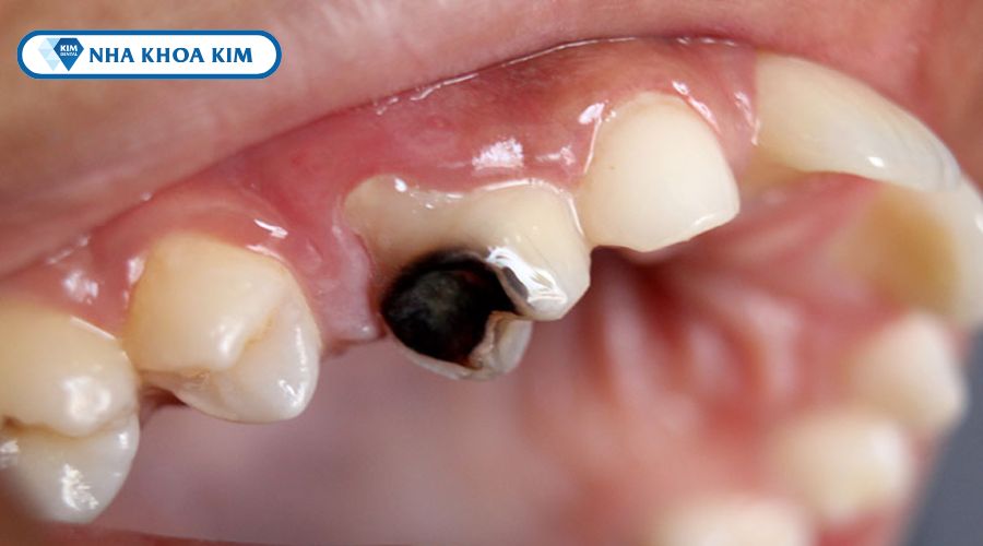 Hình ảnh sâu răng toàn phần