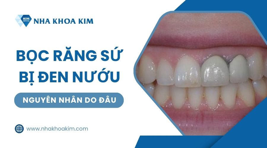 Tại sao bọc răng sứ bị đen nướu?