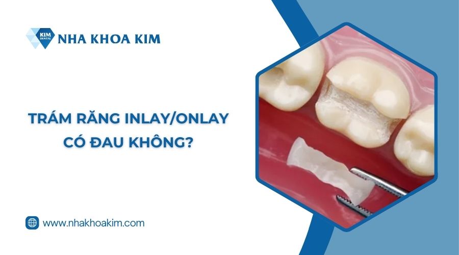 Trám răng Inlay/Onlay có đau không?