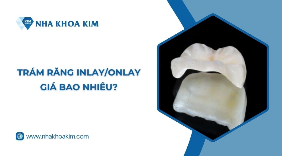 Trám răng Inlay/Onlay giá bao nhiêu?