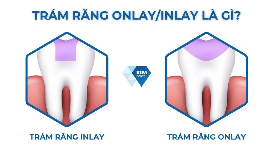 Trám răng Inlay/Onlay là gì?