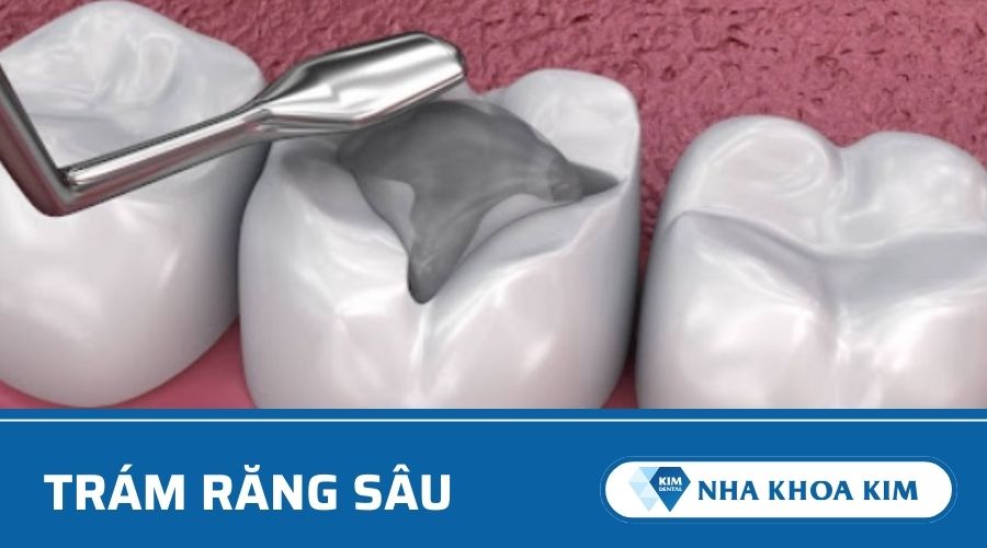 Trám răng sâu