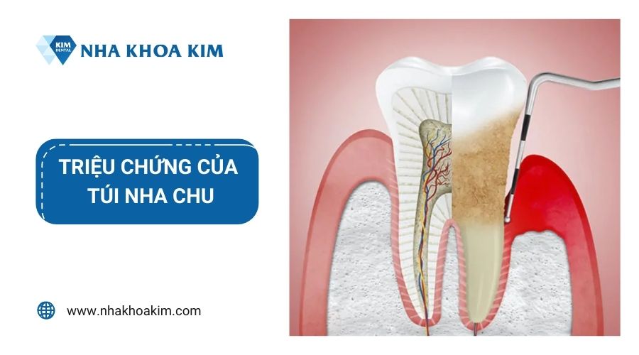 Triệu chứng của túi nha chu