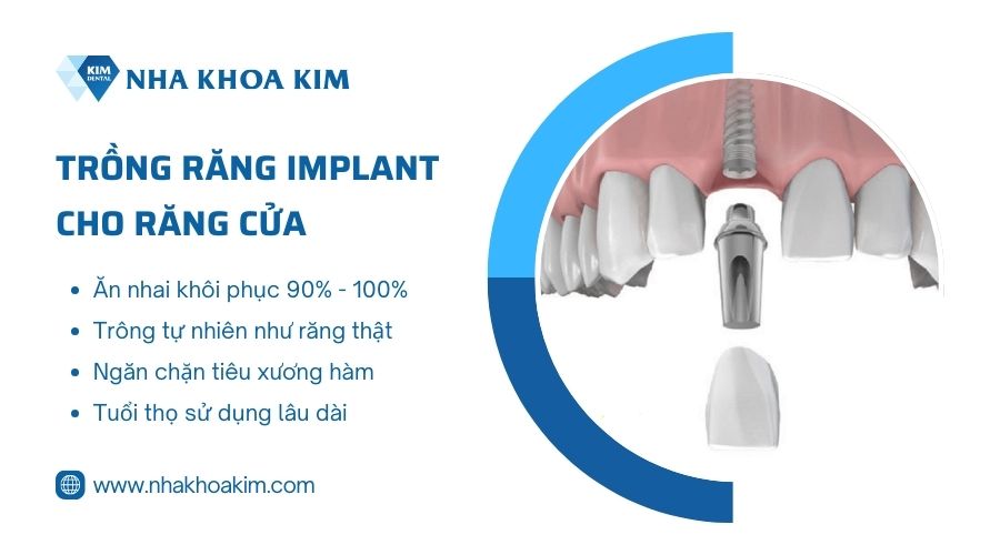 Trồng implant răng cửa
