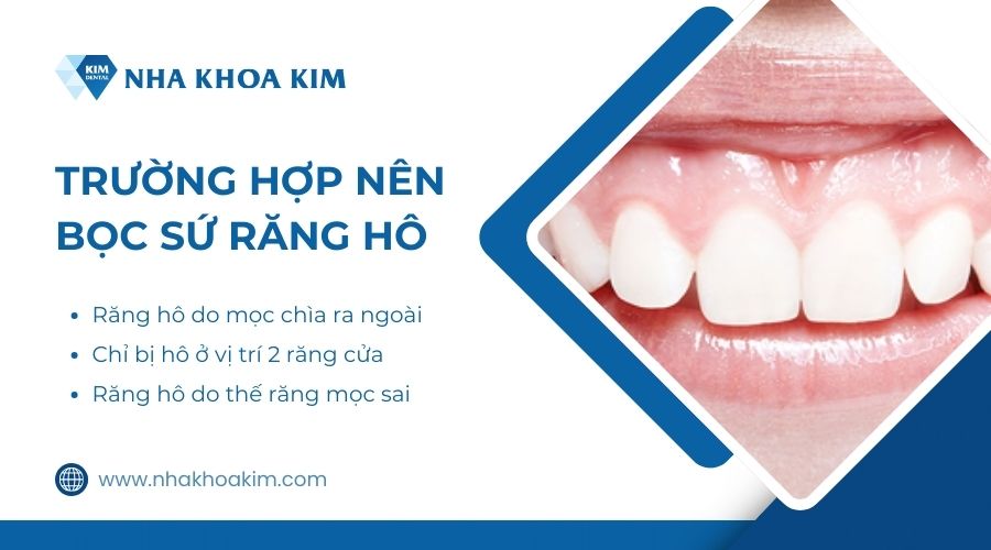 Trường hợp nên bọc sứ cải thiện răng hô