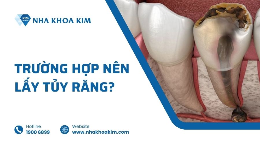 Trường hợp nào nên lấy tủy răng?