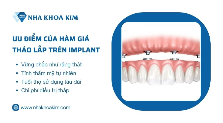 Hàm giả tháo lắp trên Implant có tốt không?