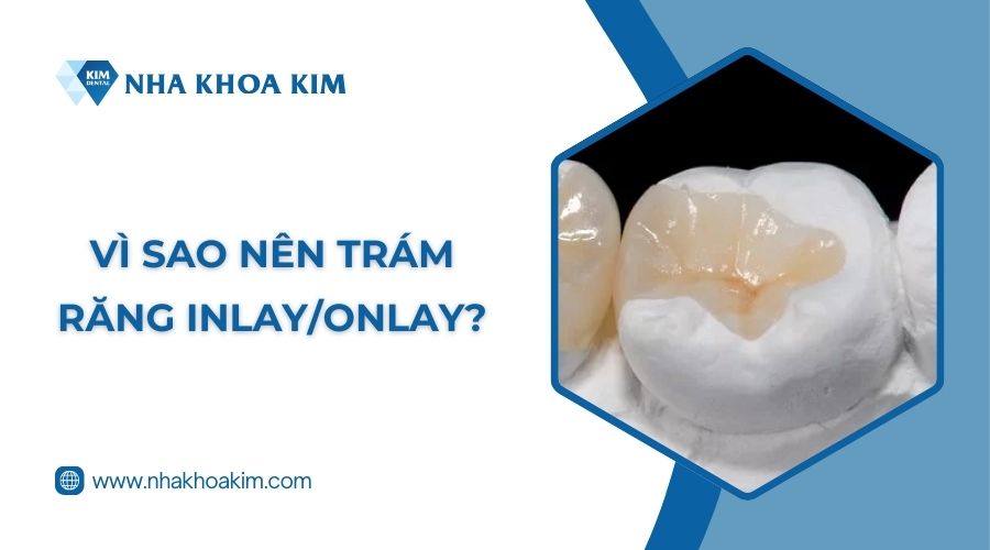 Vì sao nên trám răng Inlay/Onlay?