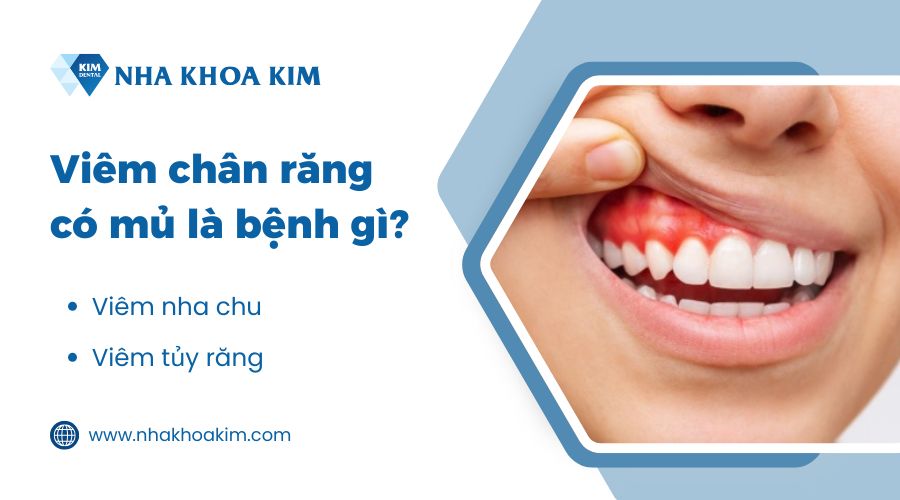 Viêm chân răng có mủ là bệnh gì?