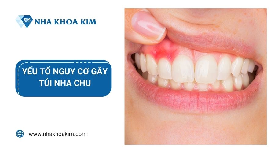 Yếu tố nguy cơ gây túi nha chu