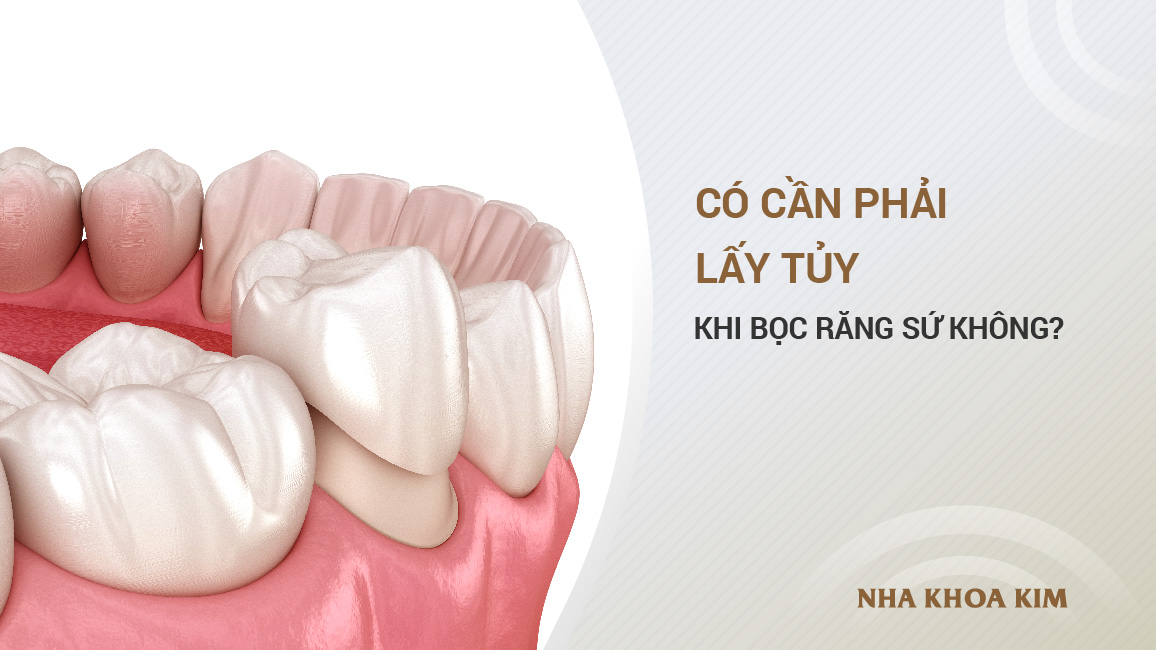 Có cần phải lấy tủy khi bọc răng sứ không?