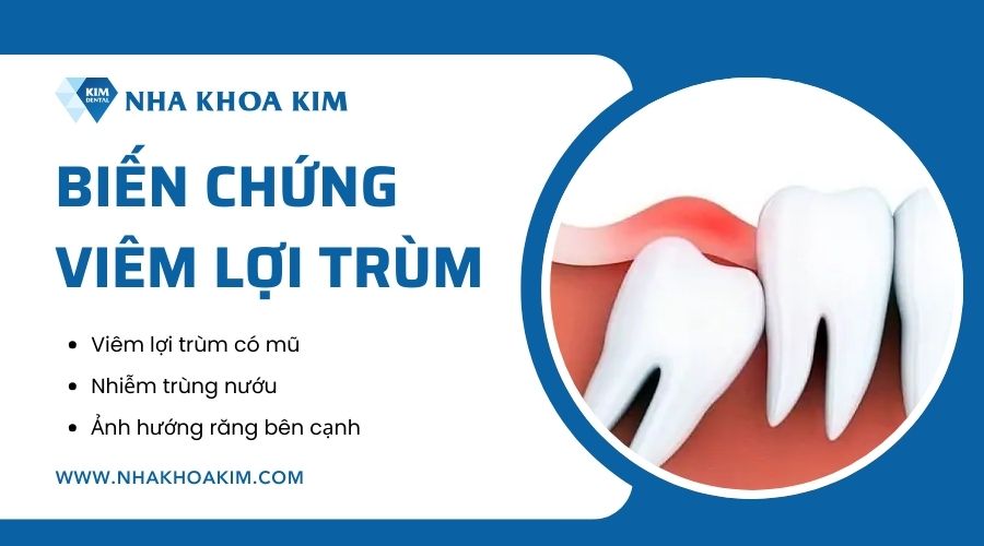 Biến chứng viêm lợi trùm