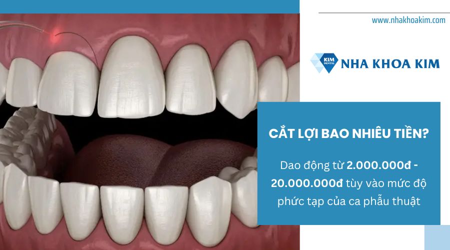 Cắt lợi bao nhiêu tiền?