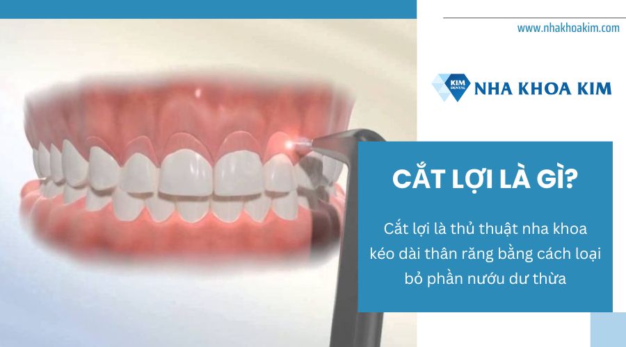 Cắt lợi là gì?
