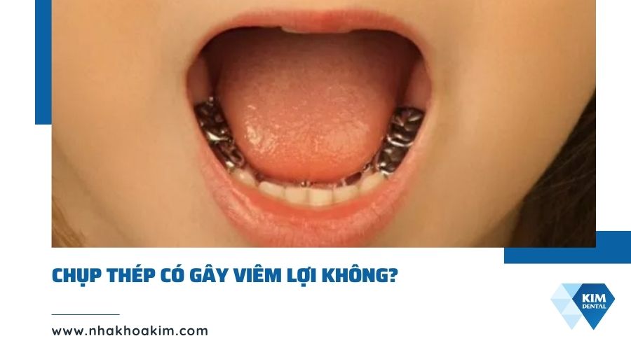Chụp thép có gây viêm lợi không?