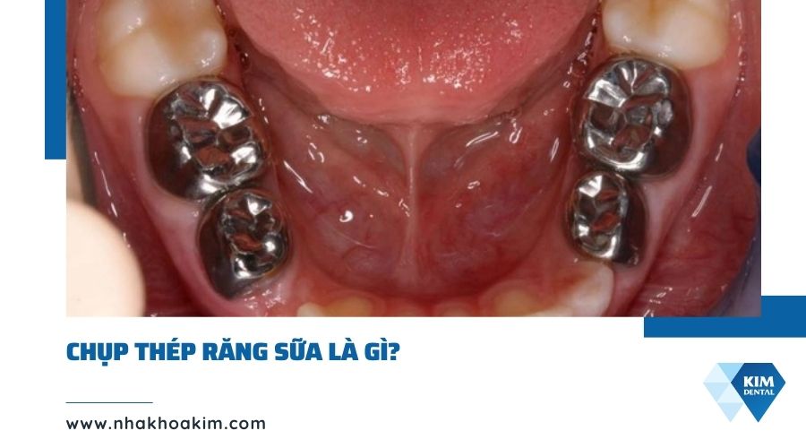 Chụp thép răng sữa là gì?