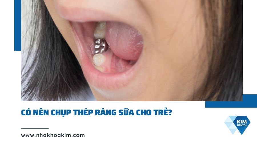 Có nên bọc thép răng sữa?