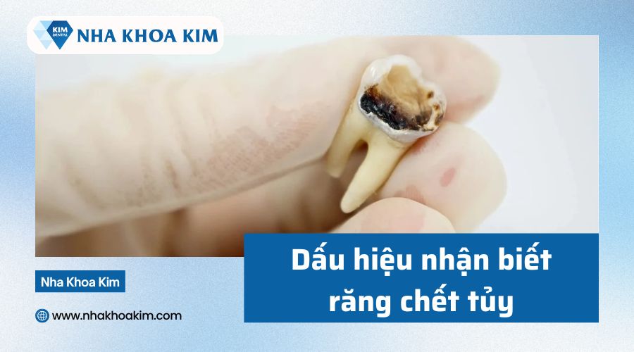 Dấu hiệu răng chết tủy