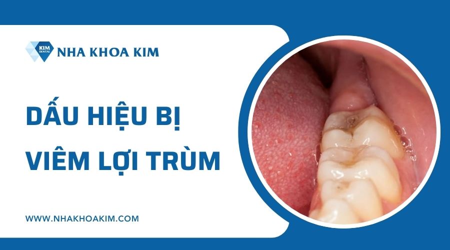 Dấu hiệu lợi trùm bị viêm