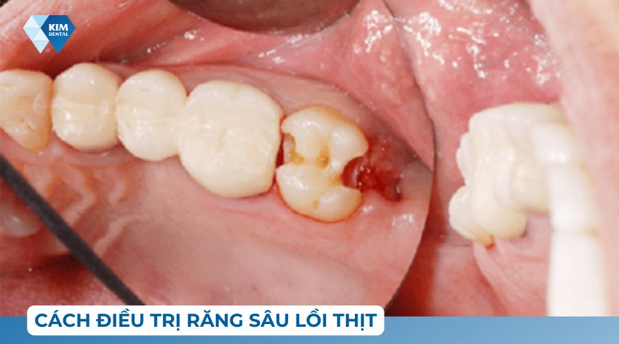 cách điều trị răng sâu lồi thịt