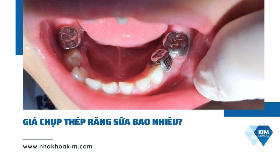 Giá chụp thép răng sữa bao nhiêu tiền?