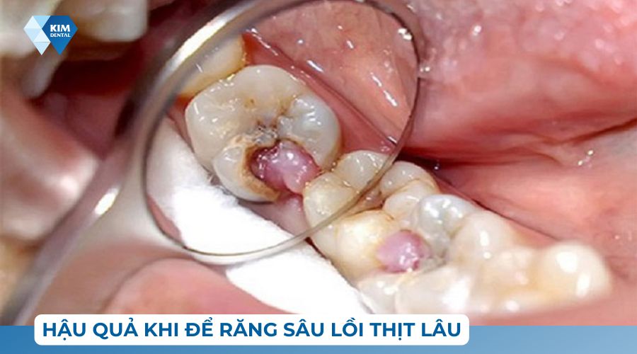 hậu quả khi để răng sâu lồi thịt
