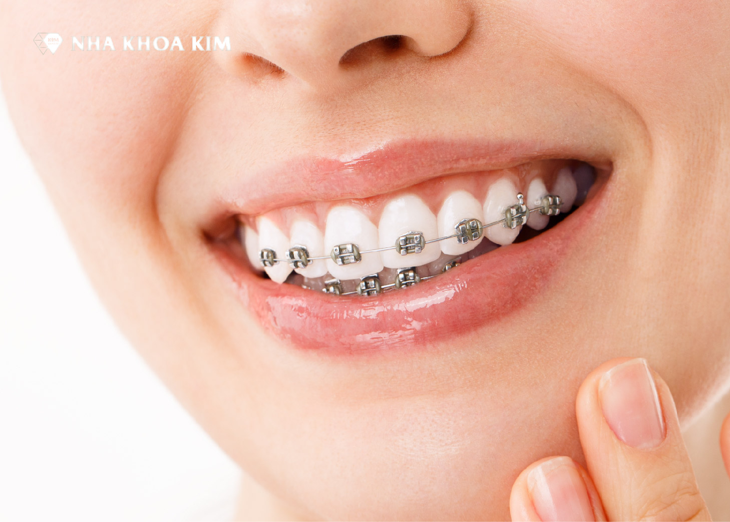 Giá niềng răng mắc cài kim loại