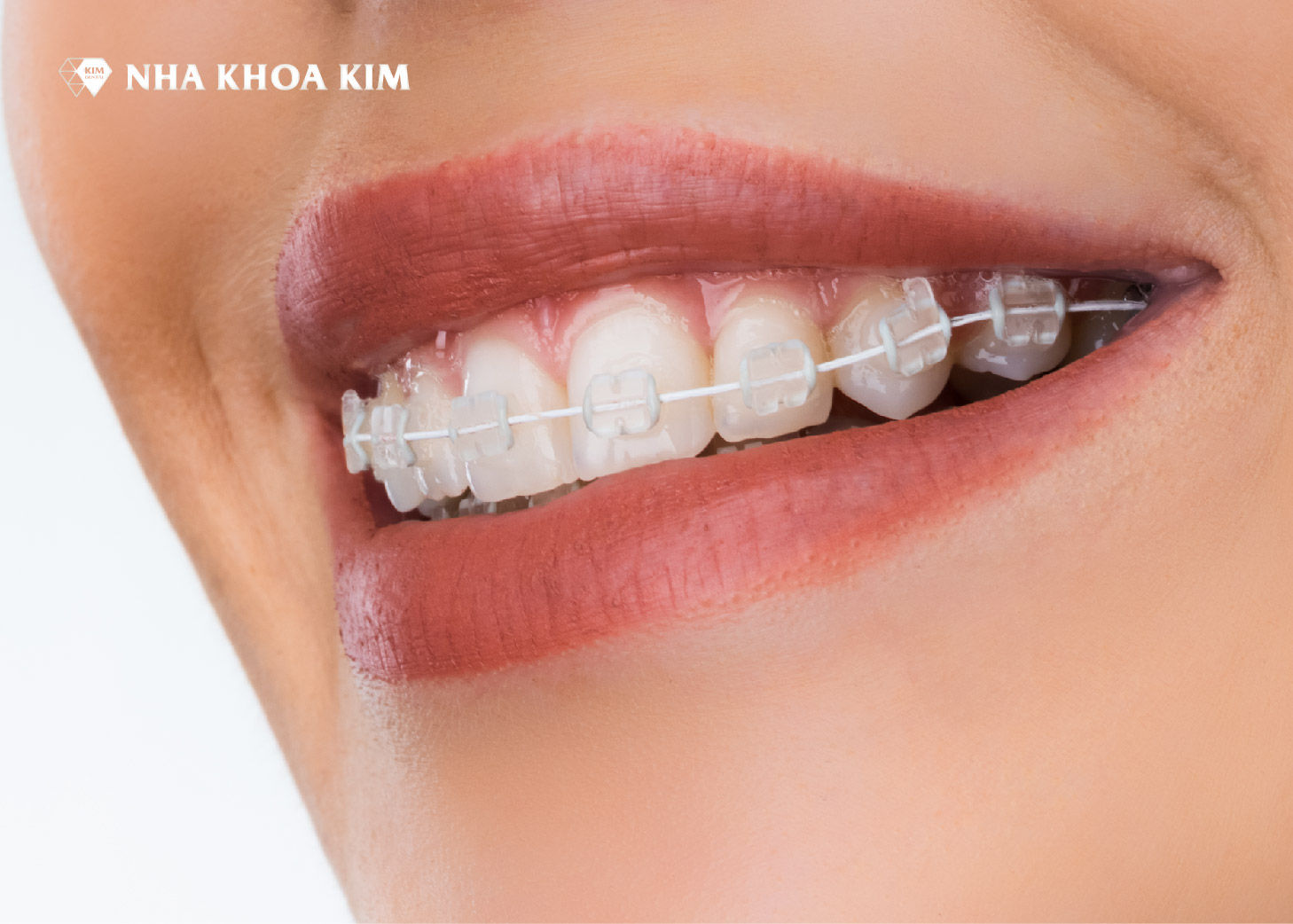Giá niềng răng mắc cài sứ