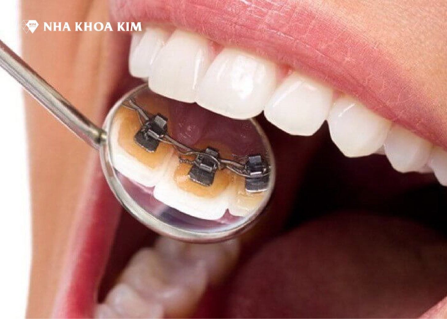 Giá niềng răng mặt trong (mặt lưỡi)
