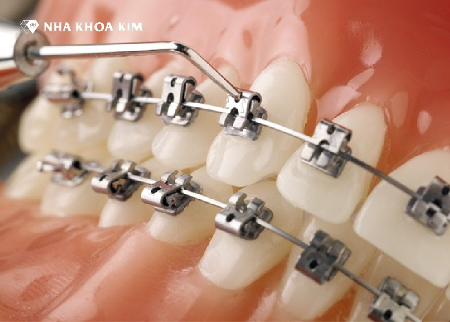 Giá niềng răng mắc cài có khóa