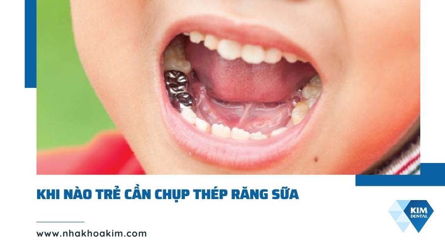 Khi nào trẻ cần chụp thép răng sữa?