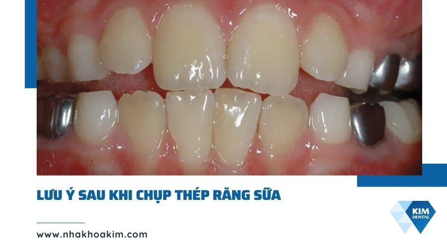 Lưu ý sau khi bọc mão răng trẻ em