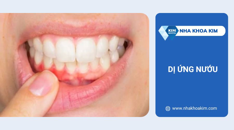Nguyên nhân gây ngứa chân răng do dị ứng
