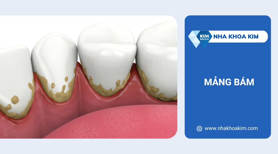 Ngứa nướu răng do mảng bám