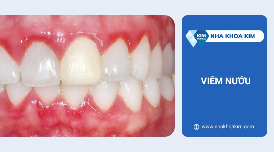 Ngứa chân răng do viêm nướu