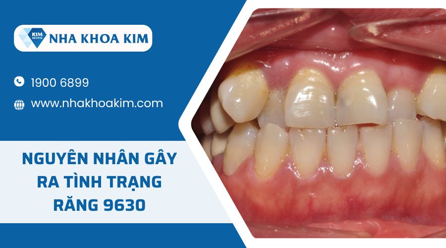 Nguyên nhân gây ra tình trạng răng 9630