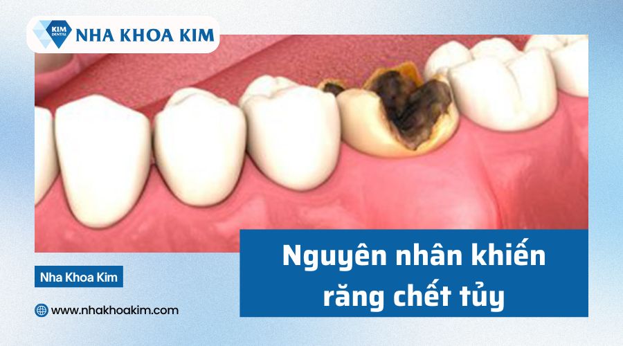 Nguyên nhân gây chết tủy răng 