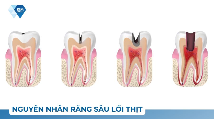 nguyên nhân răng sâu lồi thịt